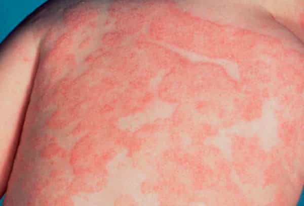 Цветной лишай