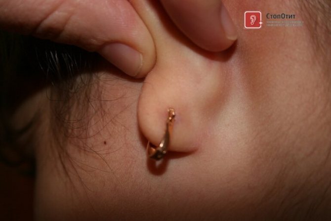 гноится мочка уха