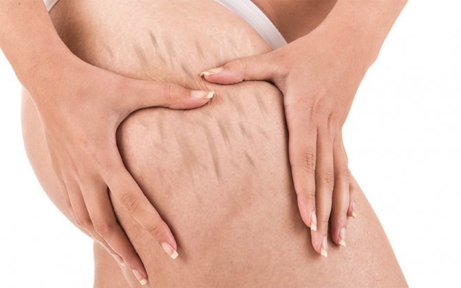 растяжки на бедрах и ногах