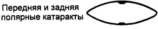 Передняя и задняя полярная катаракта Передняя и задняя полярная катаракта.