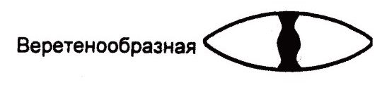 Веретенообразная катаракта Веретенообразная катаракта