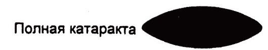 Полная катаракта Полная катаракта