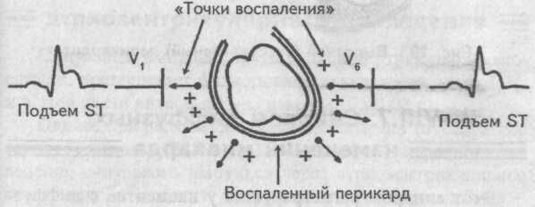 Фибринозный перикардит Фибринозный перикардит