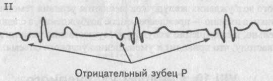 Атриовентрикулярный ритм Атриовентрикулярный ритм
