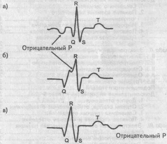 Расположение отрицательного зубца Р Расположение отрицательного зубца Р