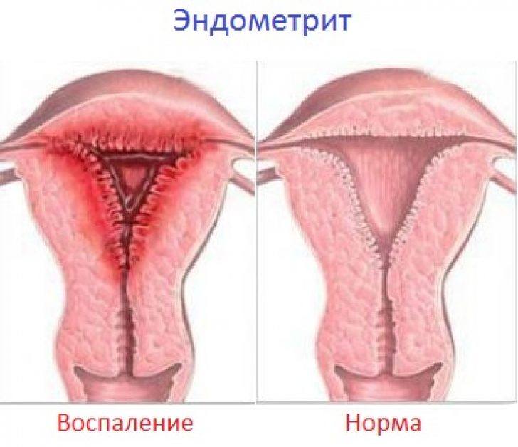 Эндометрит