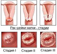 Плоскоклеточный рак шейки матки