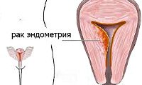 Аденокарцинома матки