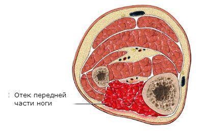 краш синдром симптомы