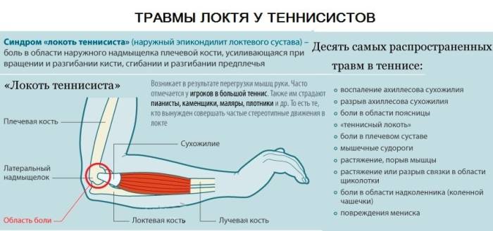 Боли в локтевом суставе синдром теннисиста