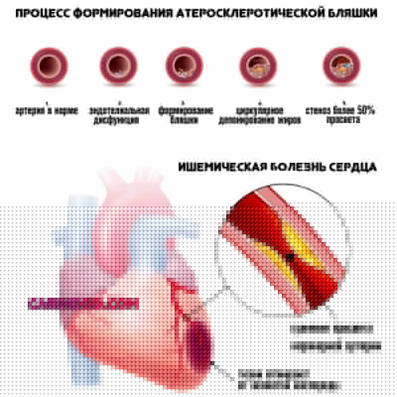 ишемическая болезнь сердца