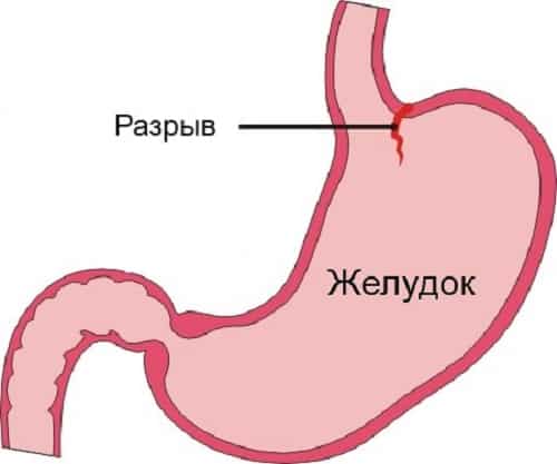Кровотечение