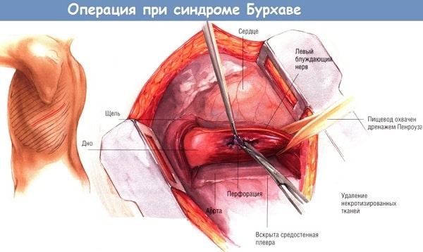 Операция