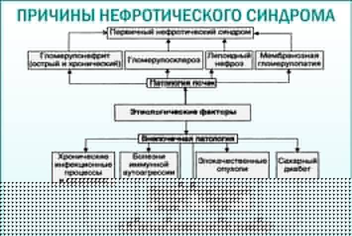 Причины нефротического синдрома Нефротический синдром: причины