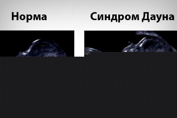 УЗИ болезнь Дауна УЗИ болезнь Дауна