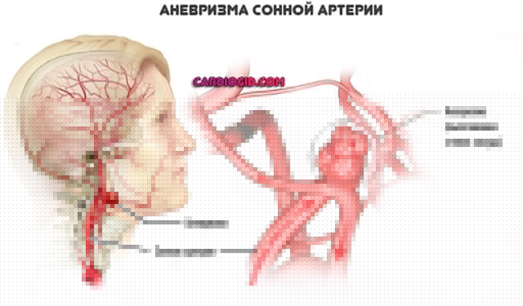 аневризма-сонной-артерии