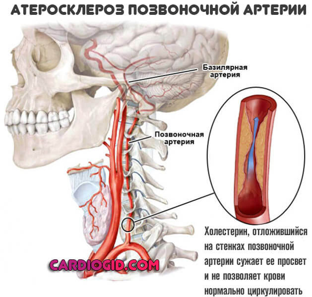 атеросклероз-позвоночной-артерии