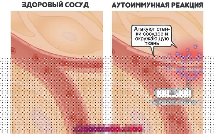 аутоиммунная-реакция