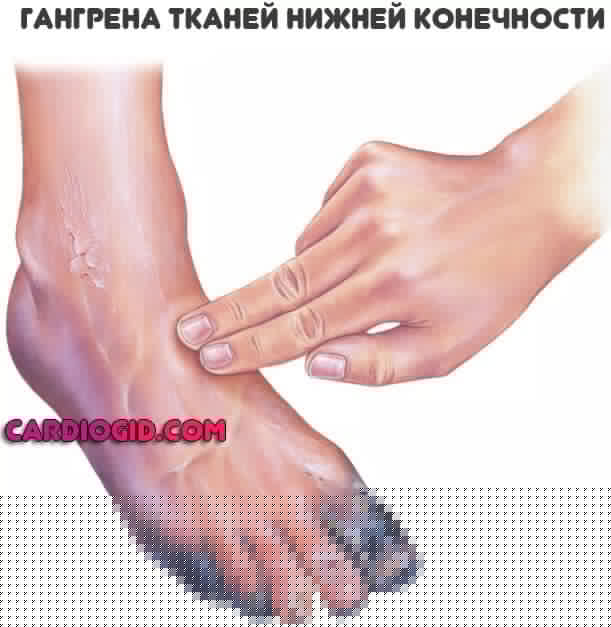 гангрена-тканей-ноги
