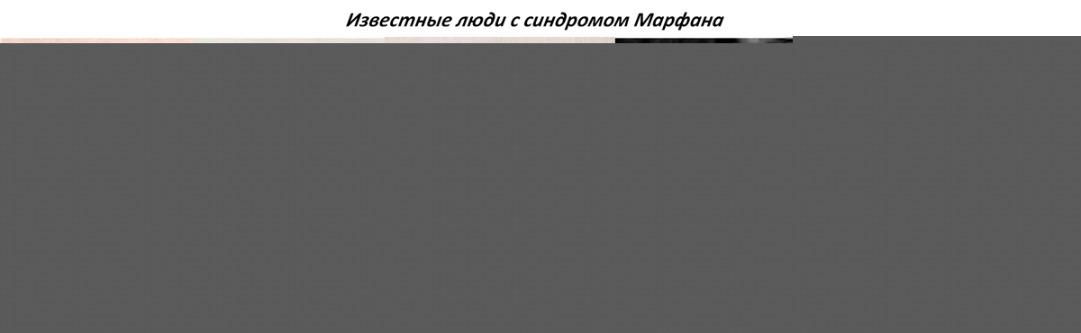 Известные люди с синдромом Марфана Известные люди с синдромом Марфана