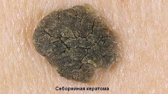 Кератома кожи - симптомы и лечение у взрослых, фото на лице, голове. Себорейная, старческая, сенильная