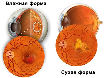 makulodistrofiya-vlazhnaya-forma-i-suhaya