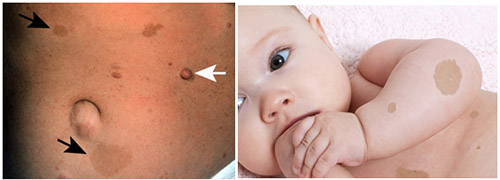 nejrofibromatoz simptomy2 Нейрофиброматоз