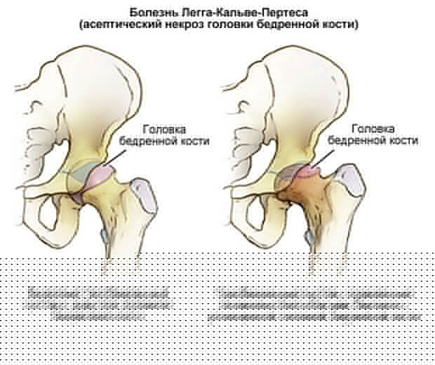 развитие заболевания