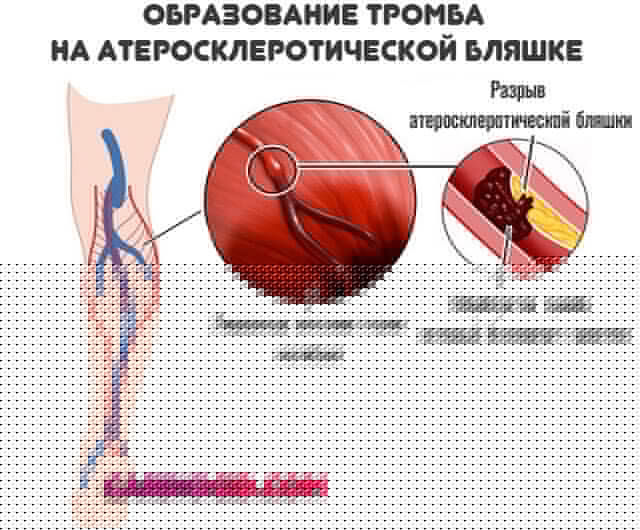 образование-тромба-на-атеросклеротической-бляшке