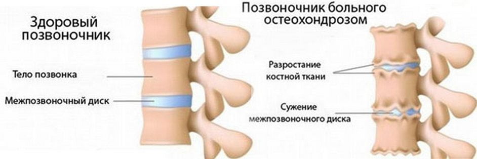 Здоровый и пораженный остеохондрозом позвоночник Остеохондроз