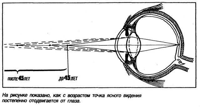 Пресбиопия - старческая дальнозоркость
