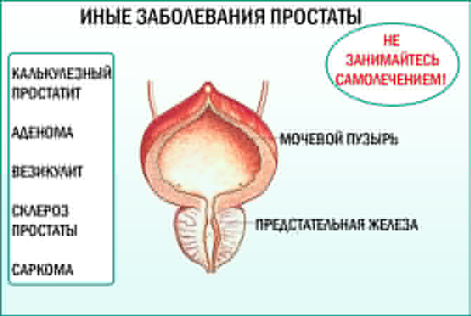 Иные заболевания предстательной железы Другие болезни простаты
