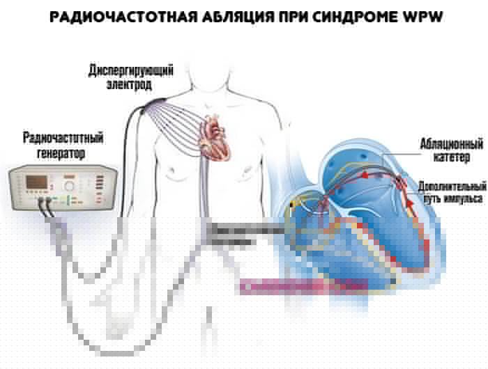 радиочастотная-абляция-при-синдроме-wpw