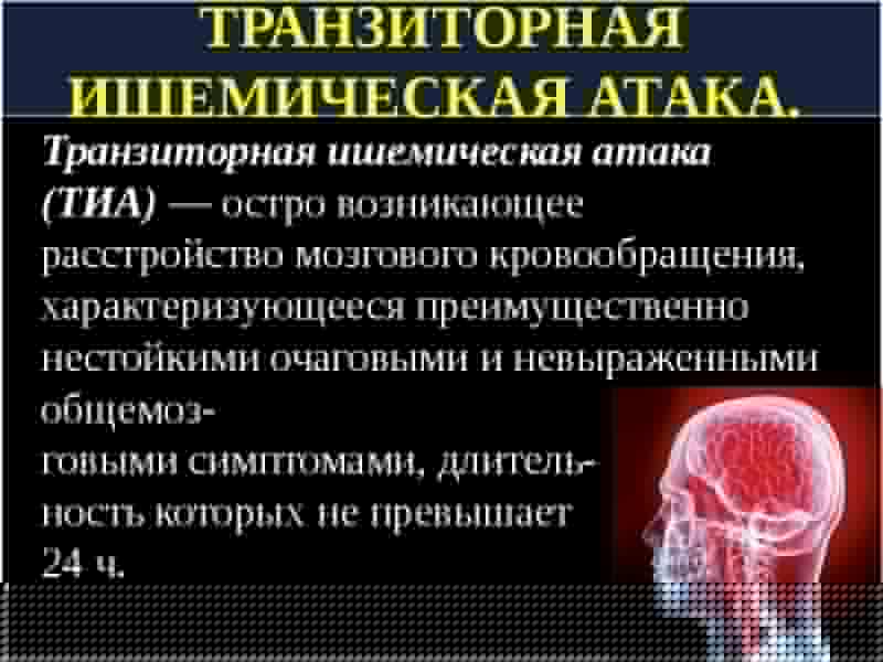 ишемическая атака