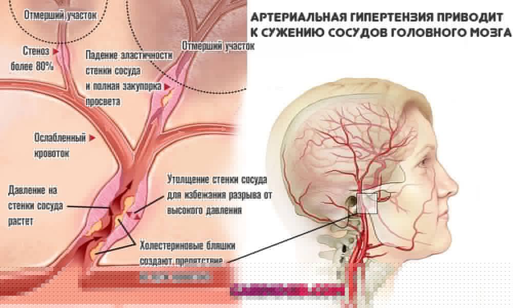 Дисциркуляторная энцефалопатия 2 степени с астено невротическим синдромом