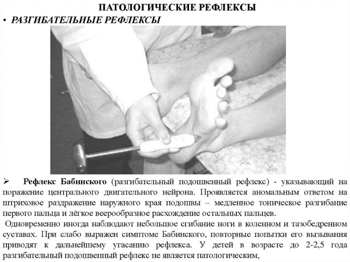 Симптом (рефлекс) Бабинского. Что это с двух сторон, справа, слева, положительный, отрицательный