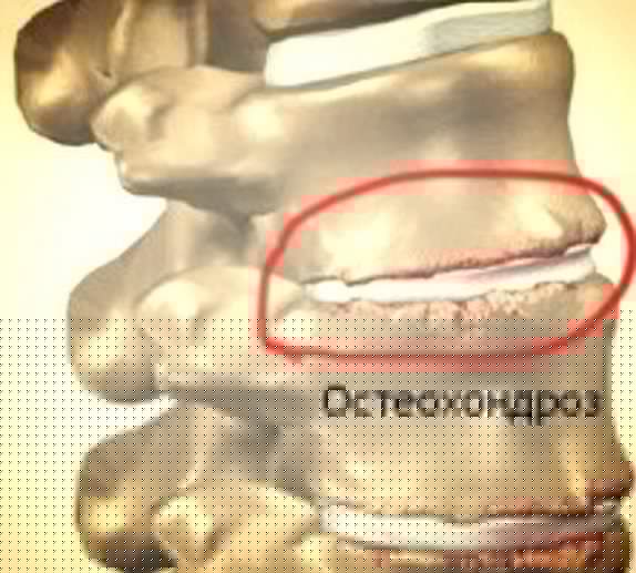 Остеохондроз грудного отдела позвоночника синдромы