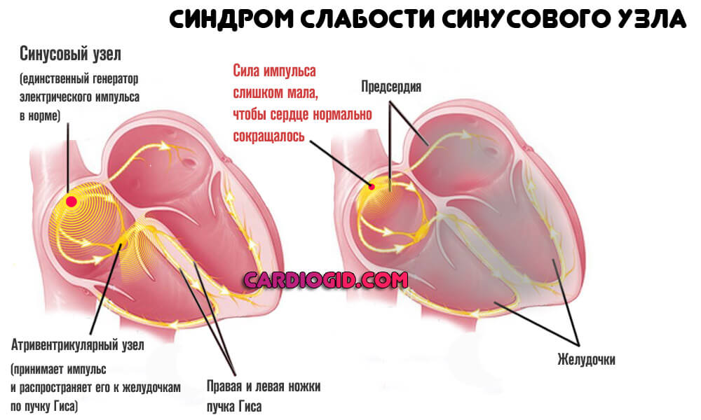 синдром-слабости-синусовго-узла