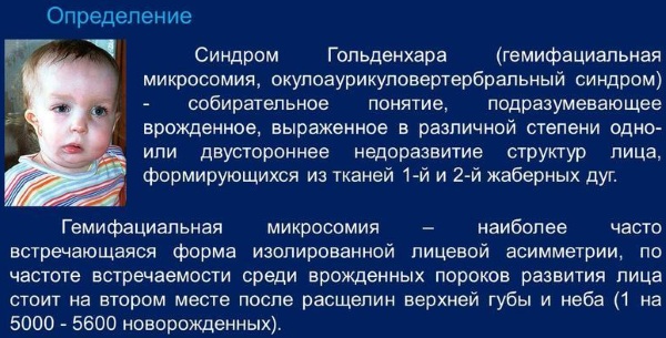 Синдром Тричера Коллинза. Фото до и после операции, причины, лечение