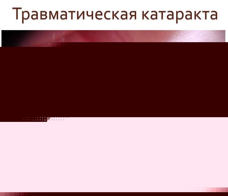 Травматическая катаракта Травматическая катаракта