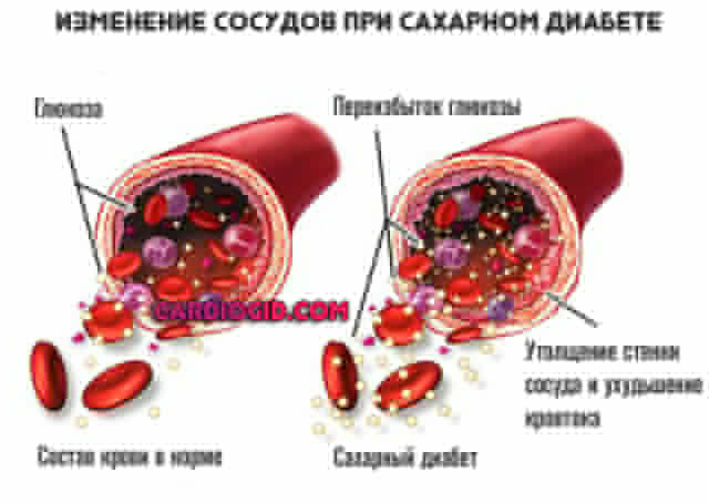 сосуды-при-диабете