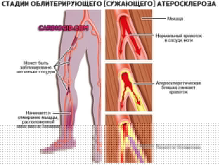 стадии-облитерирующего-атеросклероза