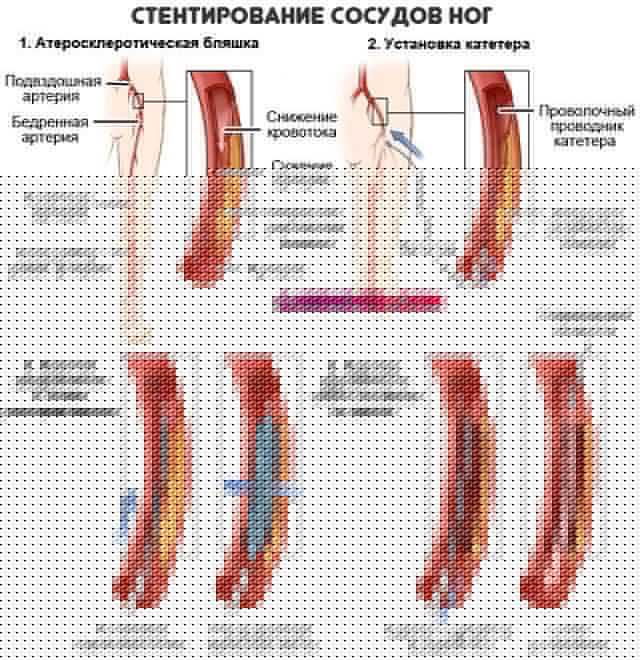 стентирование-сосудов-ног