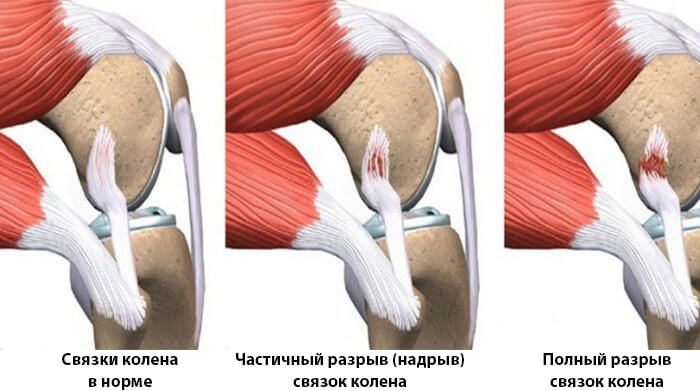 Разрыв связок колена