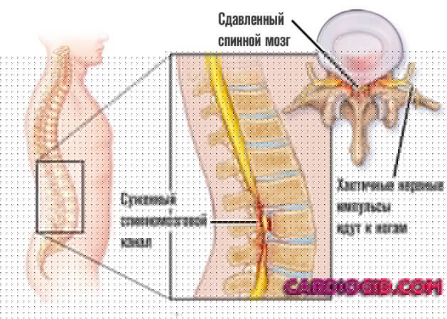 сужение-спинномозгового-канала