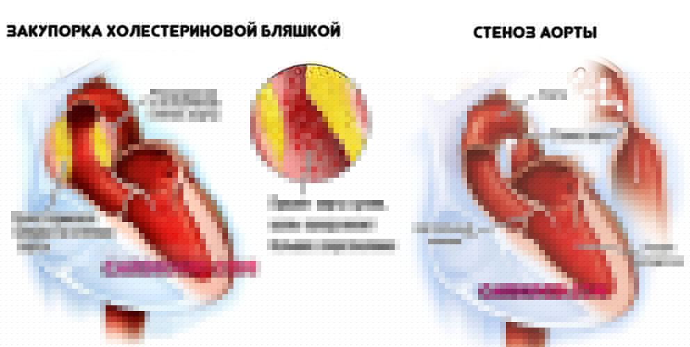 варианты-атеросклероза-аорты