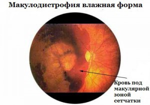 Влажная форма макулодистрофии