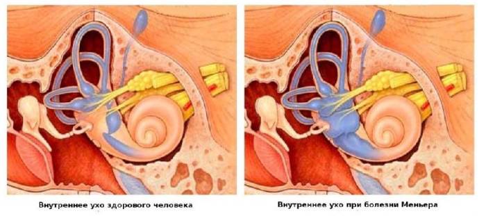 Внутренне ухо здорового человека и при болезни Меньер, выражающейся в увеличении объемов эндолимфы Какие симптомы при синдроме меньера
