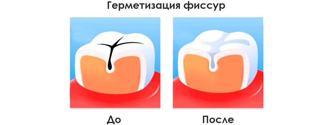 Герметизация фиссур презентация